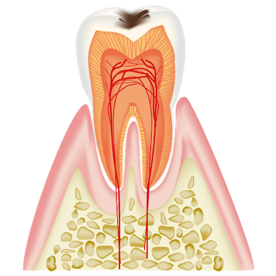 C1（初期虫歯）