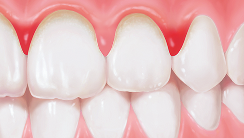 歯周病の症状：歯茎が腫れている
