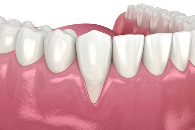 歯周病の症状：歯が長くなった（歯茎が下がっている）
