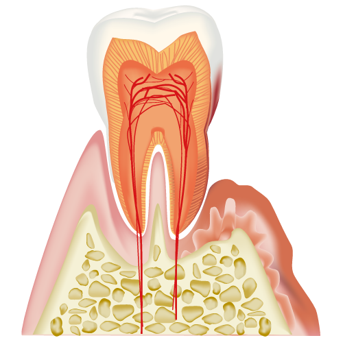 歯周病の症状：歯がぐらつく