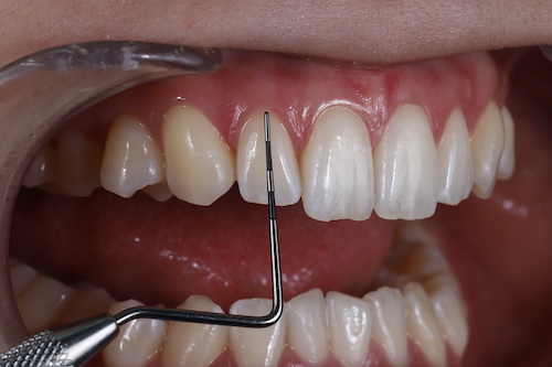 歯周ポケット・歯肉退縮量・クリニカルアタッチメントレベルの検査