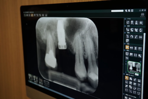 欠損歯治療：インプラント